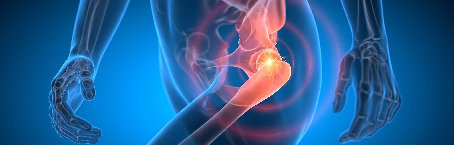 schematische Abbildung von Schmerzen im Hüftgelenk | Endo­prothetik­zentrum am Katho­lischen Kranken­haus Erfurt